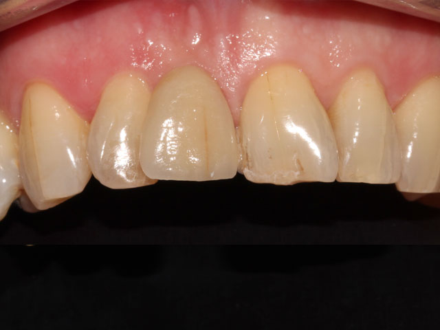 emax case study before