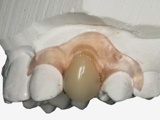 Flexible Unilateral Partial Denture